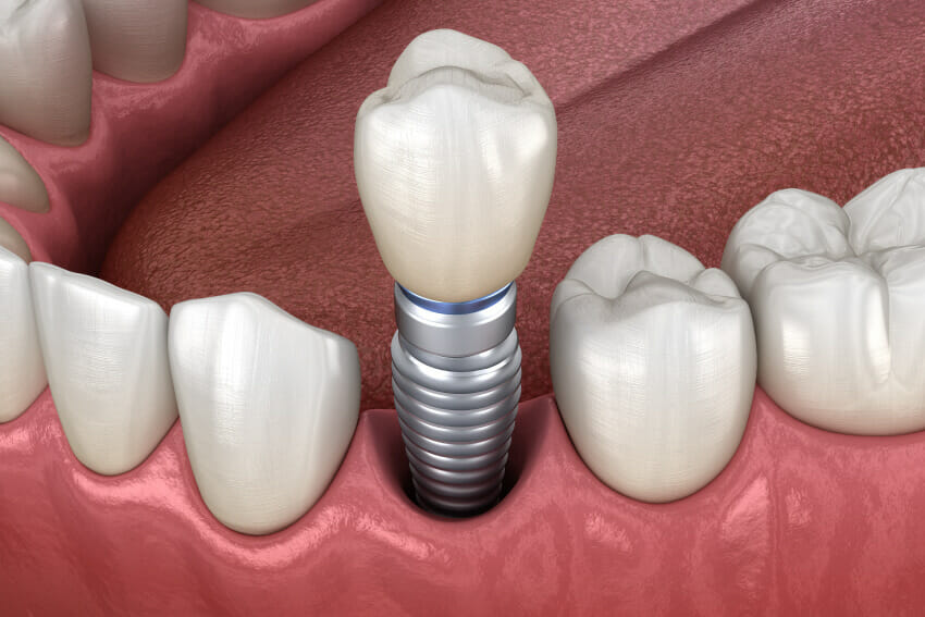 Advanced illustration of tooth being implanted into mouth