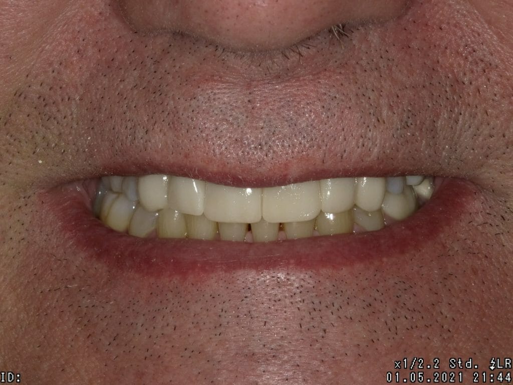 Close up of straighter teeth