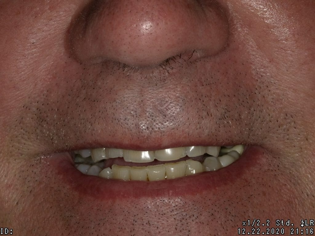 Close up of crooked teeth